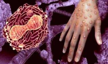 These Two New Symptoms Are Now Visible In Patients With Monkeypox, You Should Also Be Alert