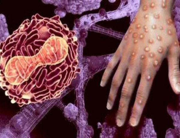 These Two New Symptoms Are Now Visible In Patients With Monkeypox, You Should Also Be Alert