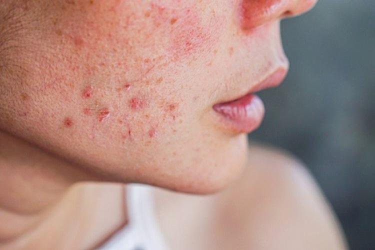 What Are Periods Of Acne? Learn Easy Home Remedies To Deal With It