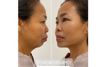 Unveiling the Fountain of Youth: Dr. Simon Ourian's Mind-Blowing Non-Surgical Breakthrough!