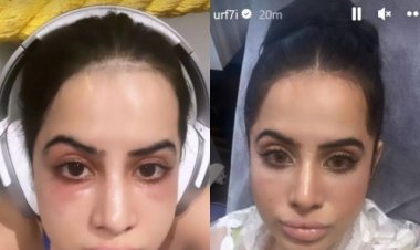 Urfi Javed's spoiled face due to under eye filler, said - Why did I do this to myself?