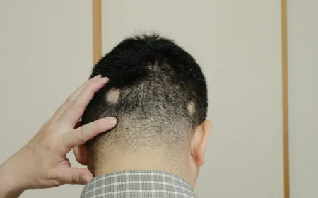 How Stress and Immunity Influence Alopecia Areata: Expert Insights and Treatments