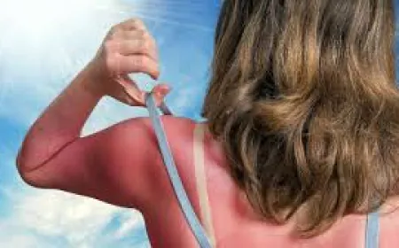 Adopt these home remedies if you are having skin irritation due to sunburn and get relief immediately