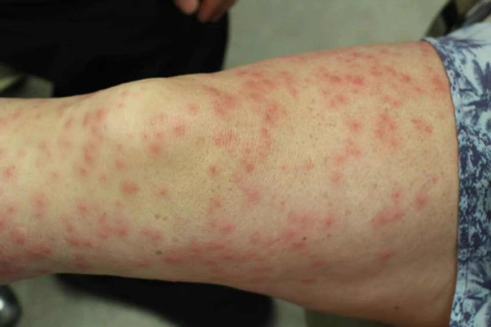 Home remedies to get rid of pimples that appear on the skin after waxing