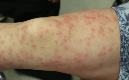 Home remedies to get rid of pimples that appear on the skin after waxing