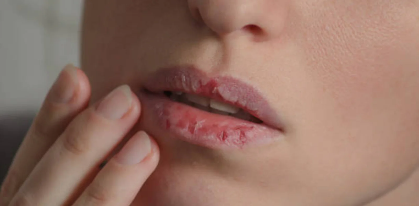 Constantly Chapped Lips? It May Be More Than Just the Weather