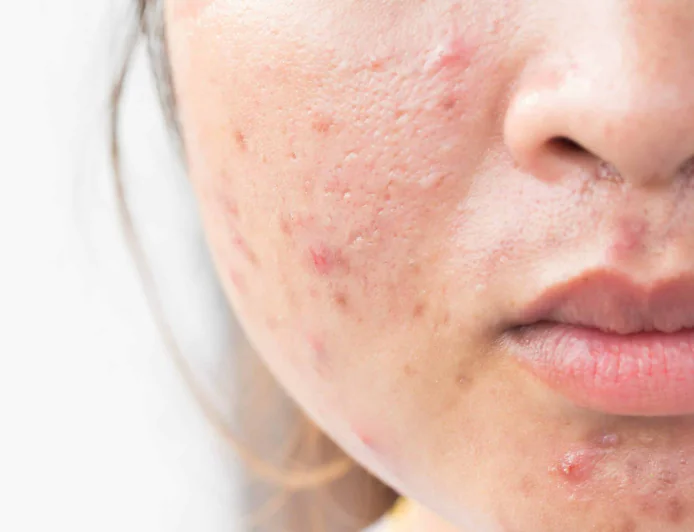 How to Get Rid of Facial Marks Using Simple Home Treatments