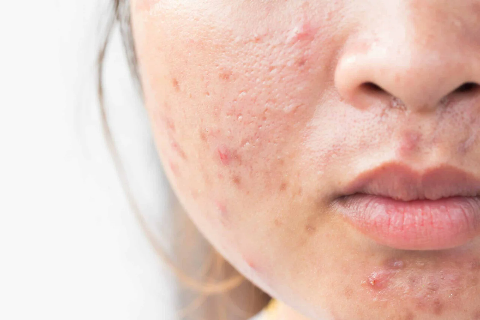How to Get Rid of Facial Marks Using Simple Home Treatments