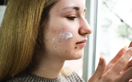 Why Acne Worsens in Winter: Causes, Skincare Tips, and Expert Advice