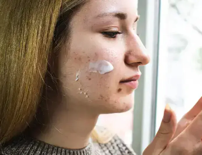 Why Acne Worsens in Winter: Causes, Skincare Tips, and Expert Advice