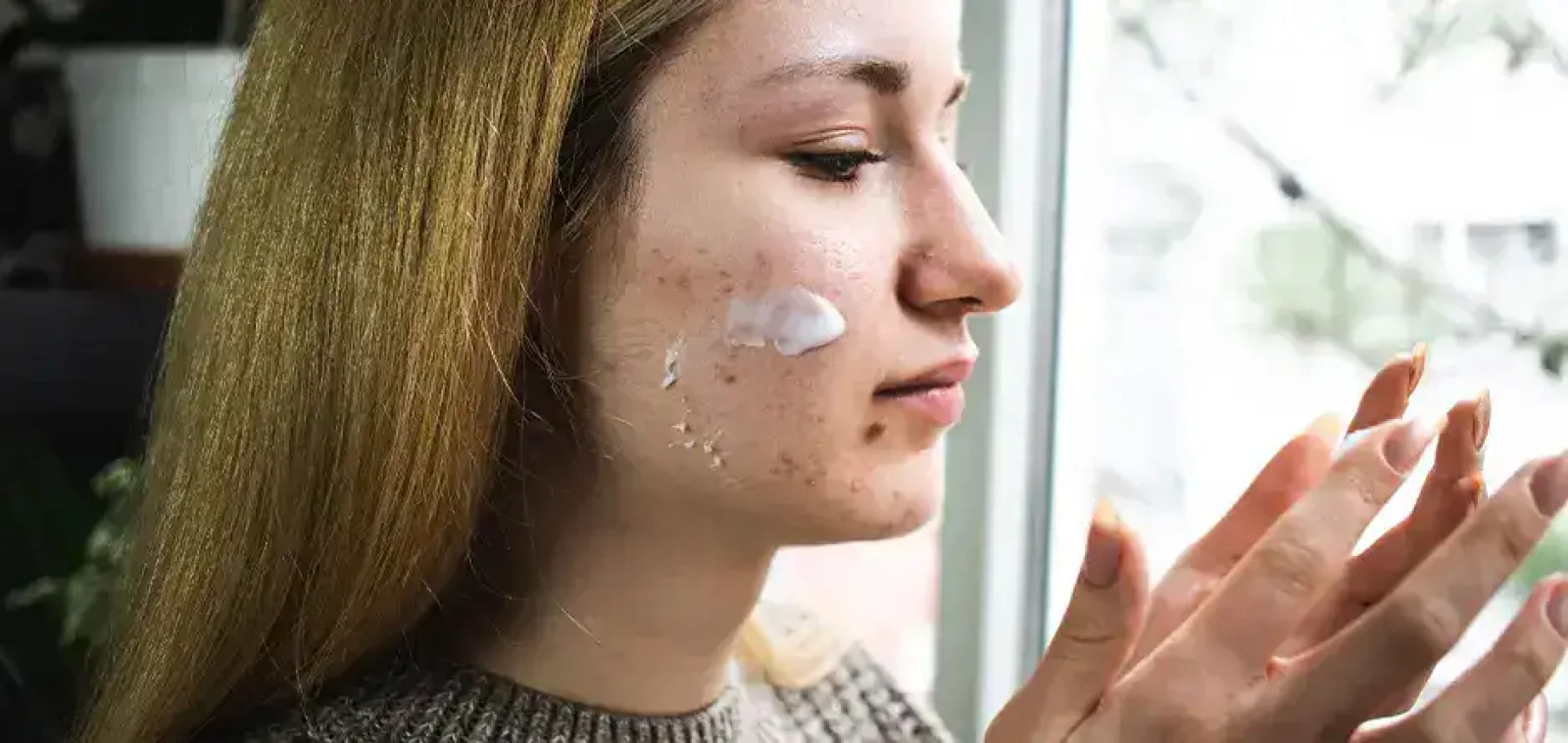 Why Acne Worsens in Winter: Causes, Skincare Tips, and Expert Advice