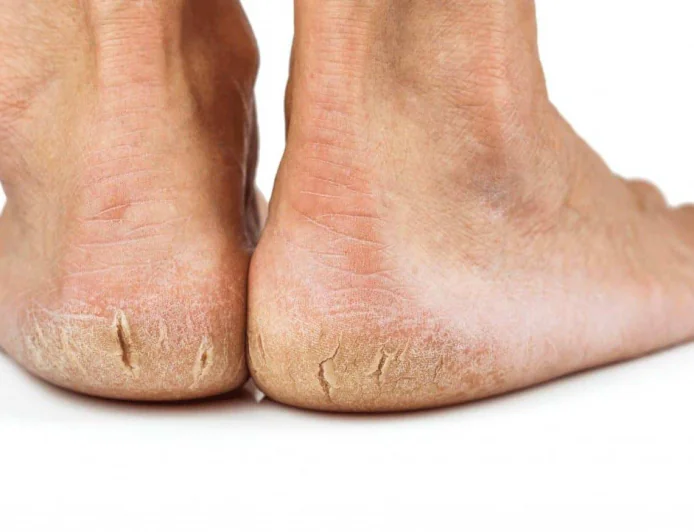 Coconut Oil to Aloe Vera: Natural Ways to Repair Dry, Cracked Heels