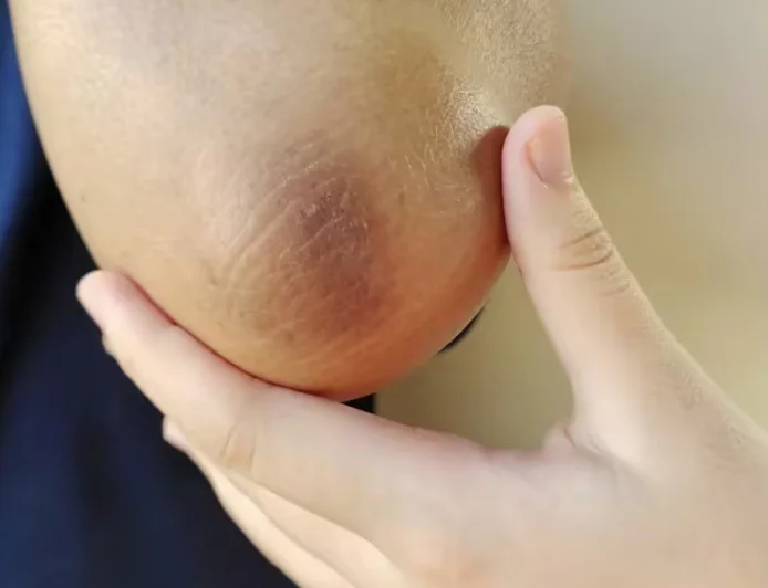 Dark Elbows and Knees? Try These Simple Kitchen Remedies to Reduce Hyperpigmentation Naturally