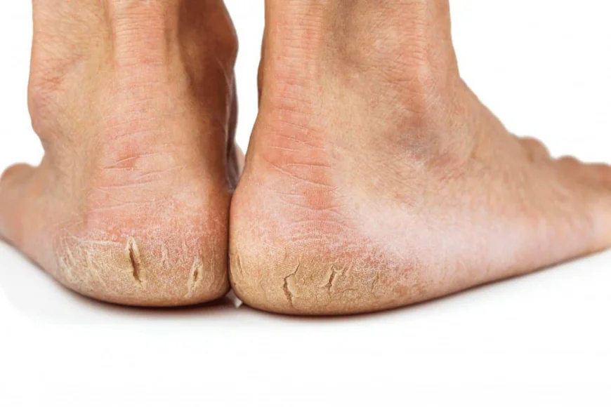 Coconut Oil to Aloe Vera: Natural Ways to Repair Dry, Cracked Heels