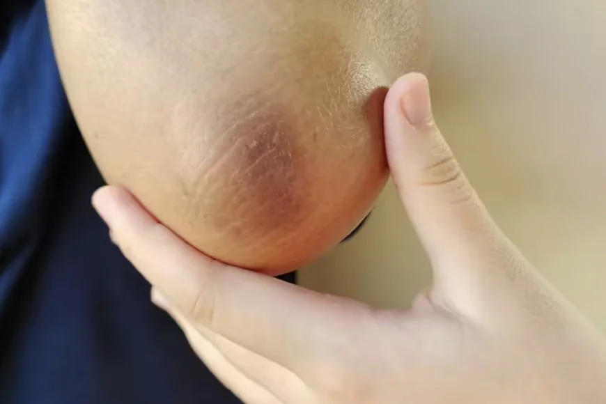 Dark Elbows and Knees? Try These Simple Kitchen Remedies to Reduce Hyperpigmentation Naturally