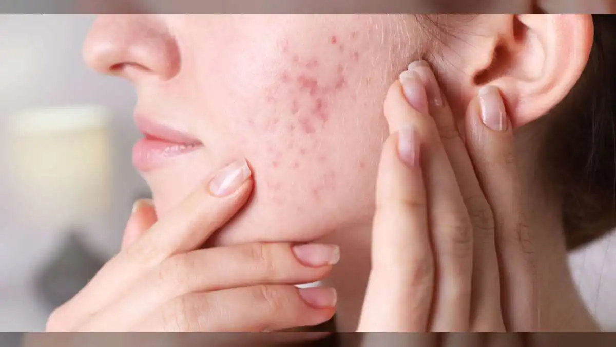 Facial Acne May Signal Hidden Health Issues Like Hormones, Digestion, and Stress