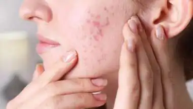 Facial Acne May Signal Hidden Health Issues Like Hormones, Digestion, and Stress