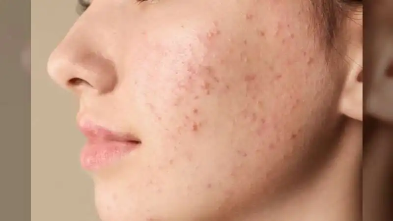 Clear Skin Tips by Dr. Niharika Goyal: Simple Habits to Prevent Pimples and Unclog Pores Naturally