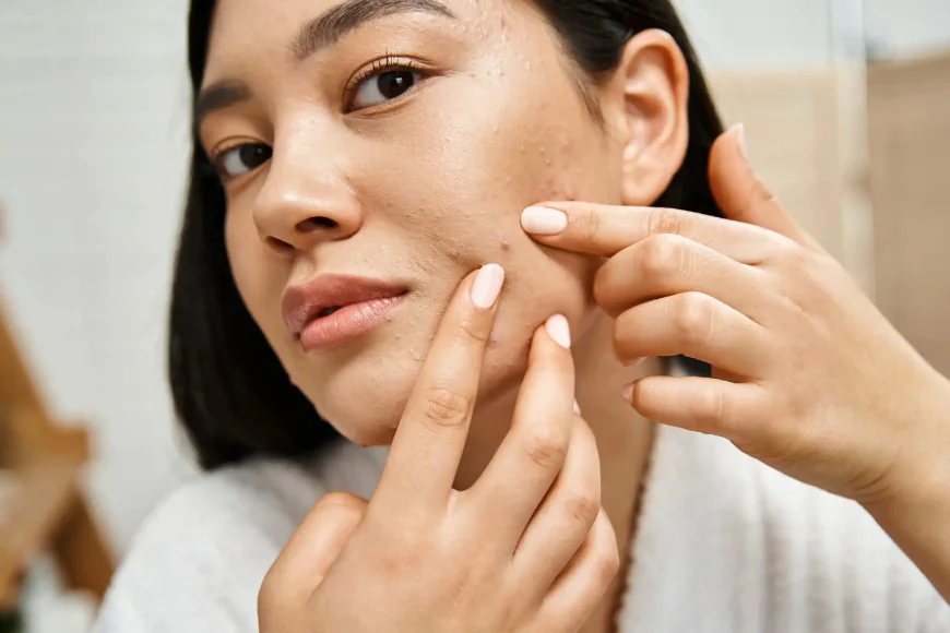 Acne-Free Skin Starts Here: Expert-Backed Hygiene Tips You Must Follow